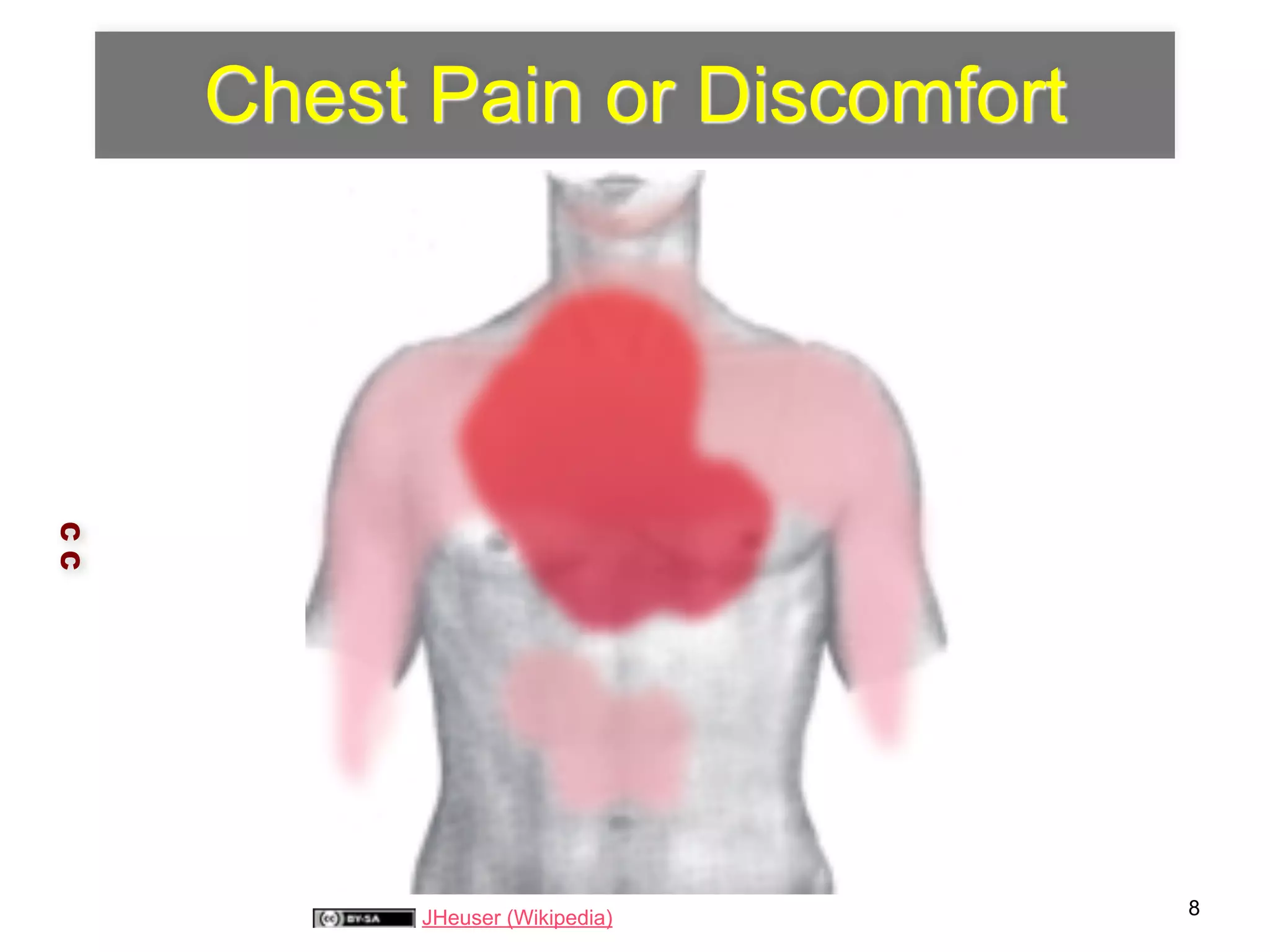 Chest Pain or Discomfort 
C C 
JHeuser (Wikipedia) 8 
 
