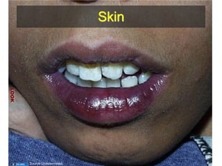 Skin 
LOOK 
31 
Source Undetermined 
 