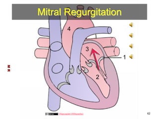 Mitral Regurgitation 
M R 
Wapcaplet (Wikipedia) 62 
 