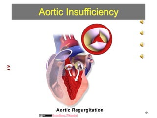 Aortic Insufficiency 
A I 
64 
BruceBlaus (Wikipedia) 
 