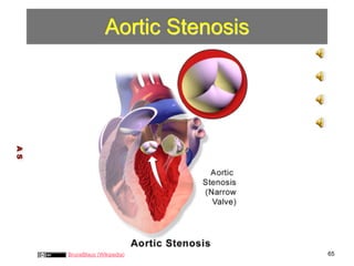 Aortic Stenosis 
A S 
BruceBlaus (Wikipedia) 65 
 