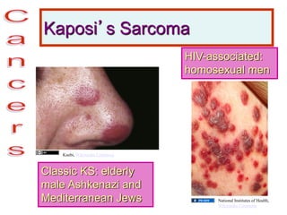 Kaposi’s Sarcoma
Classic KS: elderly
male Ashkenazi and
Mediterranean Jews
HIV-associated:
homosexual men
Kuebi, Wikimedia Commons
National Institutes of Health,
Wikimedia Commons
 
