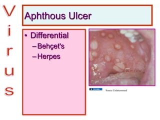 Aphthous Ulcer
• Differential
–Behçet's
–Herpes
Source Undetermined
 