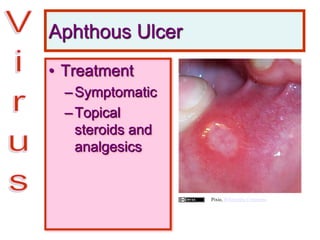 Aphthous Ulcer
• Treatment
–Symptomatic
–Topical
steroids and
analgesics
Pixie, Wikimedia Commons
 