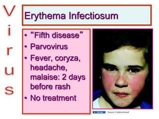 Erythema Infectiosum
• “Fifth disease”
• Parvovirus
• Fever, coryza,
headache,
malaise: 2 days
before rash
• No treatment
Source Undetermined
 