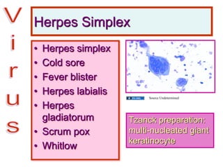 Herpes Simplex
• Herpes simplex
• Cold sore
• Fever blister
• Herpes labialis
• Herpes
gladiatorum
• Scrum pox
• Whitlow
Tzanck preparation:
multi-nucleated giant
keratinocyte
Source Undetermined
 
