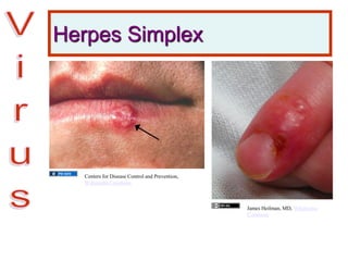 Herpes Simplex
Centers for Disease Control and Prevention,
Wikimedia Commons
James Heilman, MD, Wikimedia
Commons
 