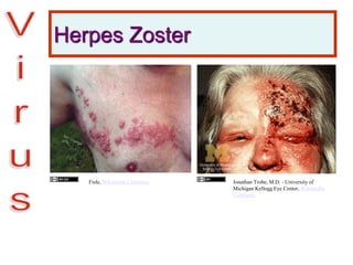 Herpes Zoster
Fisle, Wikimedia Commons Jonathan Trobe, M.D. - University of
Michigan Kellogg Eye Center, Wikimedia
Commons
 