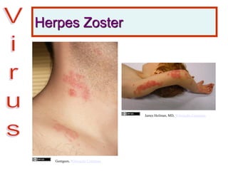 Herpes Zoster
Gentgeen, Wikimedia Commons
James Heilman, MD, Wikimedia Commons
 