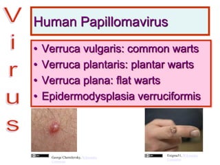 Human Papillomavirus
• Verruca vulgaris: common warts
• Verruca plantaris: plantar warts
• Verruca plana: flat warts
• Epidermodysplasia verruciformis
George Chernilevsky, Wikimedia
Commons
Enigma51, Wikimedia
Commons
 