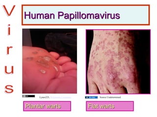 Human Papillomavirus
Plantar warts Flat warts
Source UndeterminedLynes225, Wikimedia Commons
 