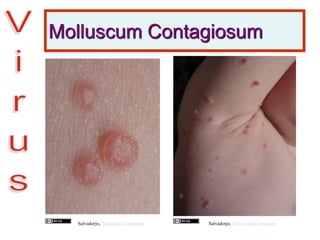 Molluscum Contagiosum
Salvadorjo, Wikimedia CommonsSalvadorjo, Wikimedia Commons
 