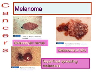 Melanoma
Melanoma in situ
Superficial spreading
melanoma
Melanocytic nevus
Centers for Disease Control and
Prevention, Wikimedia Commons
National Cancer Institute, Wikimedia
Commons
National Cancer Institute,
Wikimedia Commons
 