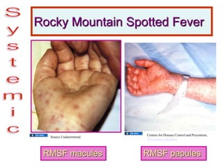 Rocky Mountain Spotted Fever
RMSF macules RMSF papules
Centers for Disease Control and Prevention,
Wikimedia Commons
Source Undetermined
 