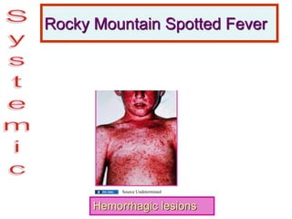 Rocky Mountain Spotted Fever
Hemorrhagic lesions
Source Undetermined
 