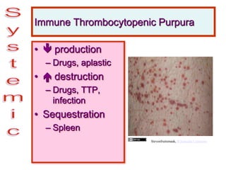 Immune Thrombocytopenic Purpura
•  production
– Drugs, aplastic
•  destruction
– Drugs, TTP,
infection
• Sequestration
– Spleen
Stevenfruitsmaak, Wikimedia Commons
 
