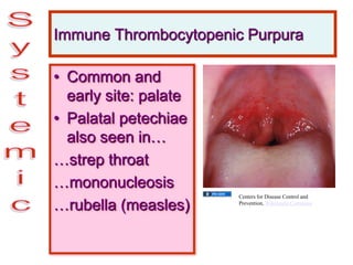 Immune Thrombocytopenic Purpura
• Common and
early site: palate
• Palatal petechiae
also seen in…
…strep throat
…mononucleosis
…rubella (measles)
Centers for Disease Control and
Prevention, Wikimedia Commons
 