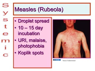 Measles (Rubeola)
• Droplet spread
• 10 – 15 day
incubation
• URI, malaise,
photophobia
• Koplik spots
Source Undetermined
 