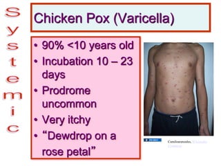 Chicken Pox (Varicella)
• 90% <10 years old
• Incubation 10 – 23
days
• Prodrome
uncommon
• Very itchy
• “Dewdrop on a
rose petal”
Camiloaranzales, Wikimedia
Commons
 