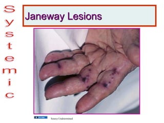 Janeway Lesions
Source Undetermined
 