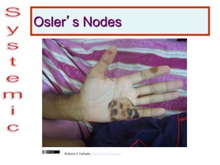 Osler’s Nodes
Roberto J. Galindo, Wikimedia Commons
 