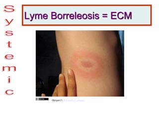 Lyme Borreleosis = ECM
Optigan13, Wikimedia Commons
 