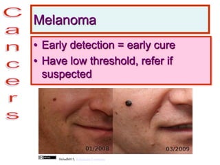Melanoma
• Early detection = early cure
• Have low threshold, refer if
suspected
0x6adb015, Wikimedia Commons
 