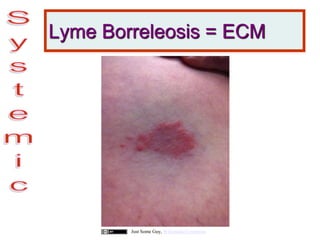Lyme Borreleosis = ECM
Just Some Guy, Wikimedia Commons
 