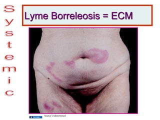 Lyme Borreleosis = ECM
Source Undetermined
 