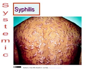 Syphilis
Herbert L. Fred, MD, Hendrik A. van Dijk, Wikimedia Commons
 