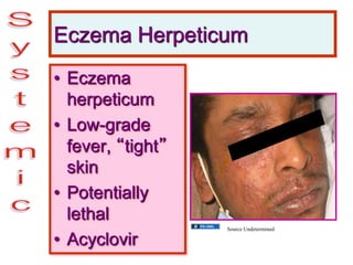 Eczema Herpeticum
• Eczema
herpeticum
• Low-grade
fever, “tight”
skin
• Potentially
lethal
• Acyclovir
Source Undetermined
 