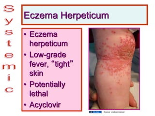 Eczema Herpeticum
• Eczema
herpeticum
• Low-grade
fever, “tight”
skin
• Potentially
lethal
• Acyclovir
Source Undetermined
 