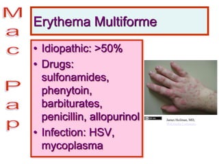 Erythema Multiforme
• Idiopathic: >50%
• Drugs:
sulfonamides,
phenytoin,
barbiturates,
penicillin, allopurinol
• Infection: HSV,
mycoplasma
James Heilman, MD,
Wikimedia Commons
 