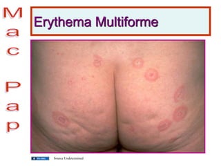 Erythema Multiforme
Source Undetermined
 