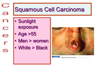 Squamous Cell Carcinoma
• Sunlight
exposure
• Age >55
• Men > women
• White > Black
National Cancer Institute, Wikimedia Commons
 