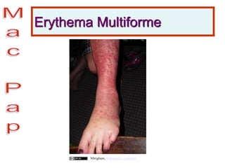 Erythema Multiforme
Nbrigham, Wikimedia Commons
 