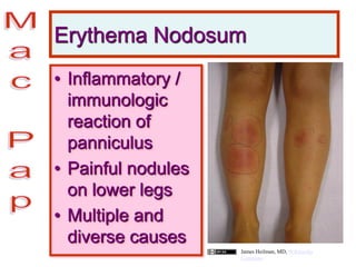 Erythema Nodosum
• Inflammatory /
immunologic
reaction of
panniculus
• Painful nodules
on lower legs
• Multiple and
diverse causes
James Heilman, MD, Wikimedia
Commons
 