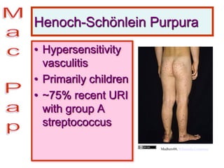 Henoch-Schönlein Purpura
• Hypersensitivity
vasculitis
• Primarily children
• ~75% recent URI
with group A
streptococcus
Madhero88, Wikimedia Commons
 