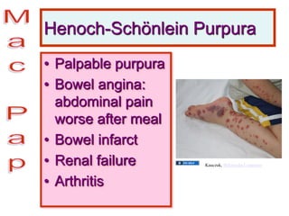 Henoch-Schönlein Purpura
• Palpable purpura
• Bowel angina:
abdominal pain
worse after meal
• Bowel infarct
• Renal failure
• Arthritis
Kauczuk, Wikimedia Commons
 