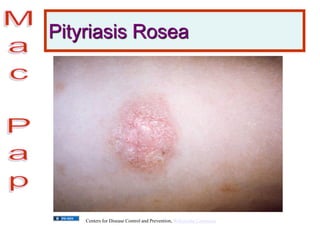 Pityriasis Rosea
Centers for Disease Control and Prevention, Wikimedia Commons
 