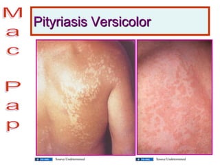 Pityriasis Versicolor
Source Undetermined Source Undetermined
 