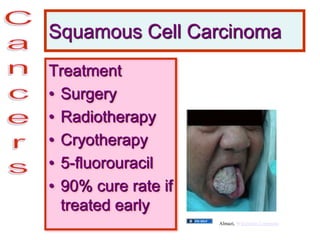 Squamous Cell Carcinoma
Treatment
• Surgery
• Radiotherapy
• Cryotherapy
• 5-fluorouracil
• 90% cure rate if
treated early
Almazi, Wikimedia Commons
 