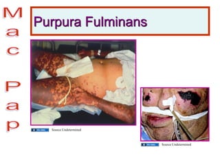 Purpura Fulminans
Source Undetermined
Source Undetermined
 