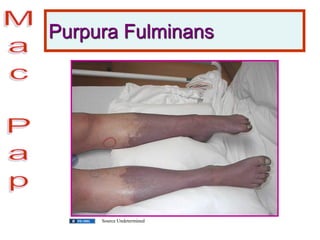 Purpura Fulminans
Source Undetermined
 