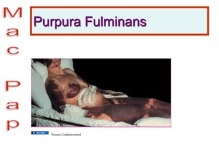 Purpura Fulminans
Source Undetermined
 