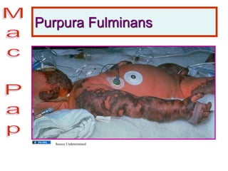 Purpura Fulminans
Source Undetermined
 