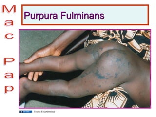 Purpura Fulminans
Source Undetermined
 