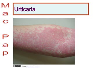 Urticaria
Jmh649, Wikimedia Commons
 