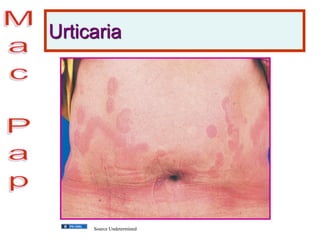 Urticaria
Source Undetermined
 