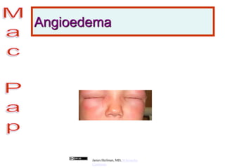 Angioedema
James Heilman, MD, Wikimedia
Commons
 